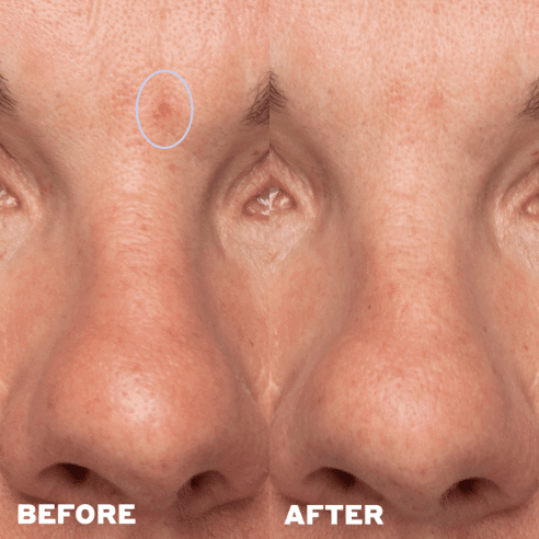 before/after